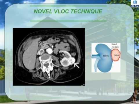 Laparoscopic Partial Nephrectomy - Novel Use of the VLOC suture to Reduce Warm Ischemia- PART 1