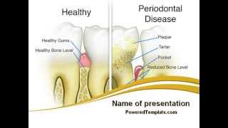 Periodontal Tooth PowerPoint Template by PoweredTemplate.com