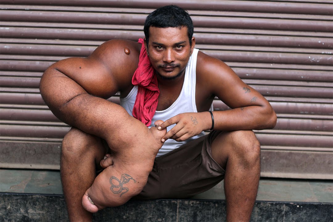 The Man With The 44lb Arm