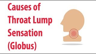 Causes of Throat Lump Sensation (Globus)