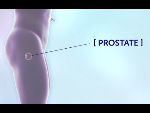 Hogyan lehet eltávolítani a prosztatitis gyulladását otthon