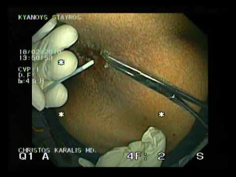 Anal Papillae - Laserotherapy
