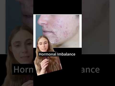 Signs Of Hormonal Imbalance #dermatologist