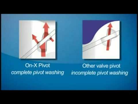 On-X Mechanical Heart Valve