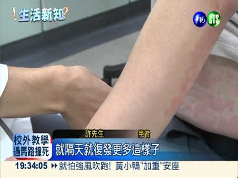 泡湯治感冒? 蕁麻疹上身皮在癢