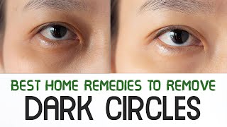 Home Remedy For Dark Circles Under Eyes (Naturally At Home)