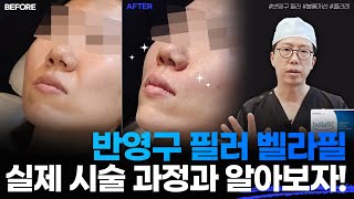 [광주벨라성형외과]영구필러아테필시술 동영상