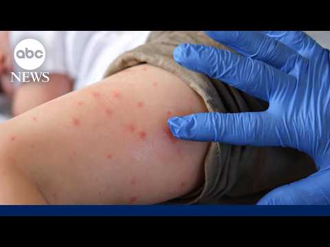 Growing Pennsylvania measles outbreak