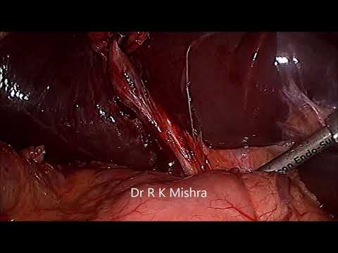 Laparoscopic Cholecystectomy With Mishra Knot