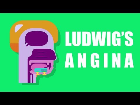 What is Ludwig's Angina?
