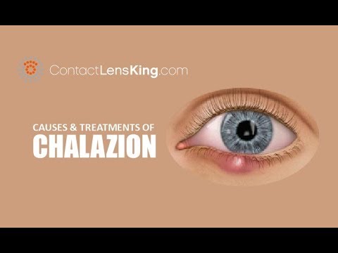 Chalazion és homályos látás. Chalazion-kezelés terhesség alatt