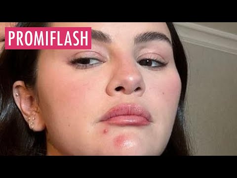 Ungeschminkt: Selena Gomez steht zu ihrer unreinen Haut