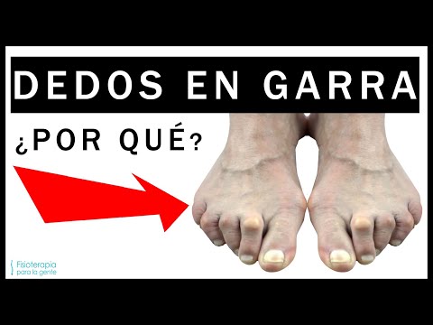 10 Causas Dedos en Garra 🦶