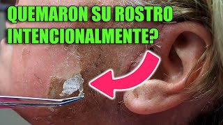 🔴 PEELING QUÍMICO Más fuerte de todos🍋 TCA , Peeling facial - PROFUNDO 🔥