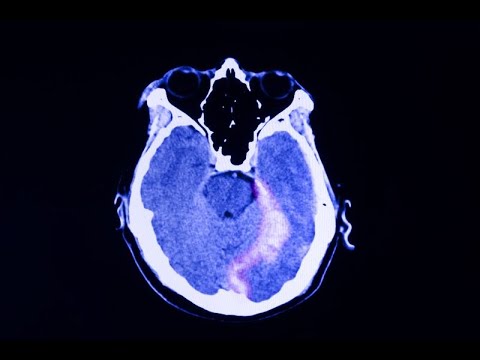 Traumatic Brain Injury Video