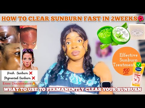 HOW TO CLEAR SUNBURN FAST + Top Products To Permanently Erase Discoloration + Best Sunburn Treatment