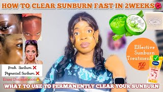 HOW TO CLEAR SUNBURN FAST + Top Products To Permanently Erase Discoloration + Best Sunburn Treatment