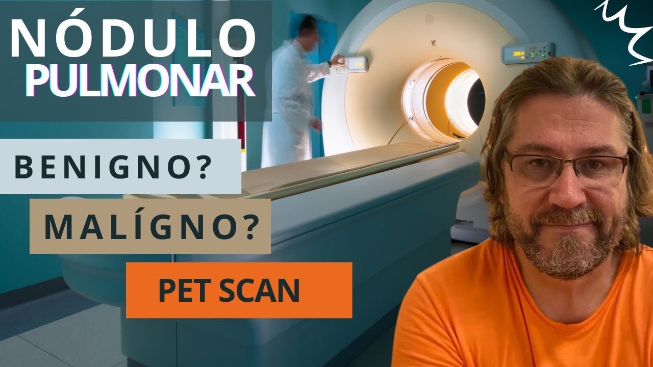 Nodulo pulmonar: Pet Scan avalia se é benigno maligno