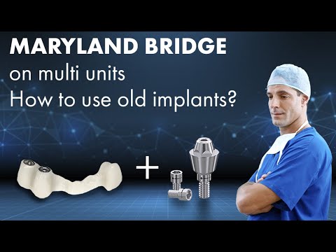 MARYLAND dental BRIDGE on multi units | How to use old dental implants | Digital impression