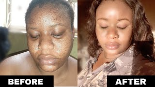 Get Rid of Tiny Bumps on Face | Small Head Bumps & Pimples