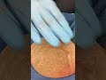 😮Dr.Castañeda and 20 years old implants removed #plasticsurgeon #breastimplants #surgery #implant