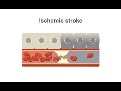 Managing the ischemic stroke patient–Neurology Masterclass
