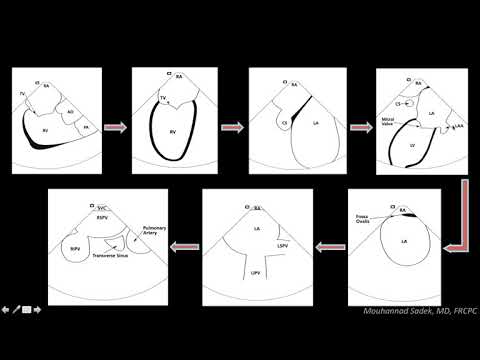 Intracardiac Echocardiography in EP Procedures - How can it help?