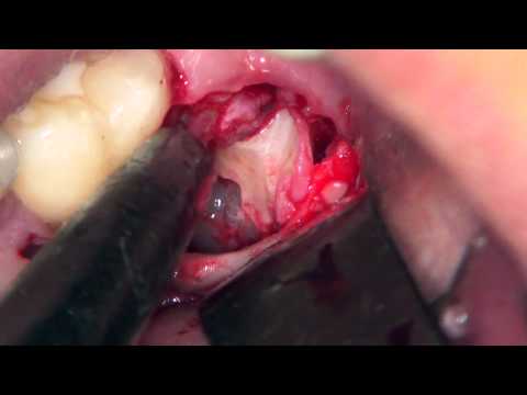 Germectomy of inferior wisdom tooth with an alternative instrument. 