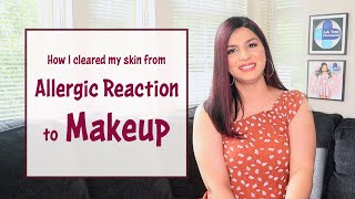 Allergic reaction to makeup | How to clear skin after an allergic reaction | Makeup allergy