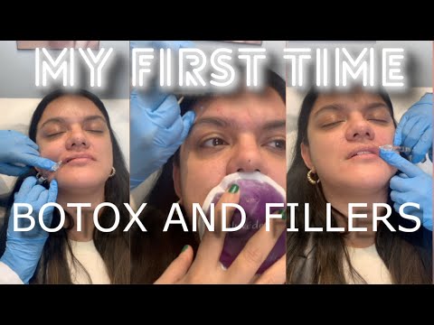 LIP FILLER (1ML) AND FOREHEAD BOTOX - BEFORE AND AFTER (First Timer)