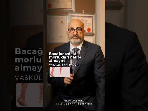 Bacağınızdaki morlukları hafife almayın!
