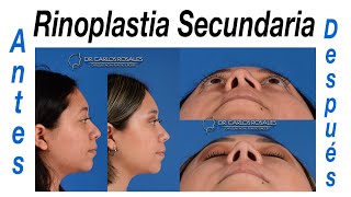 Rinoplastia secundaria antes y después