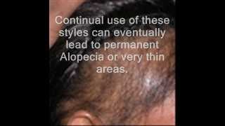 preview picture of video 'Possible Balding/ Hair Loss Cure?'