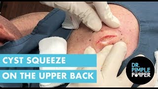 Cyst Squeeze on the Upper Back
