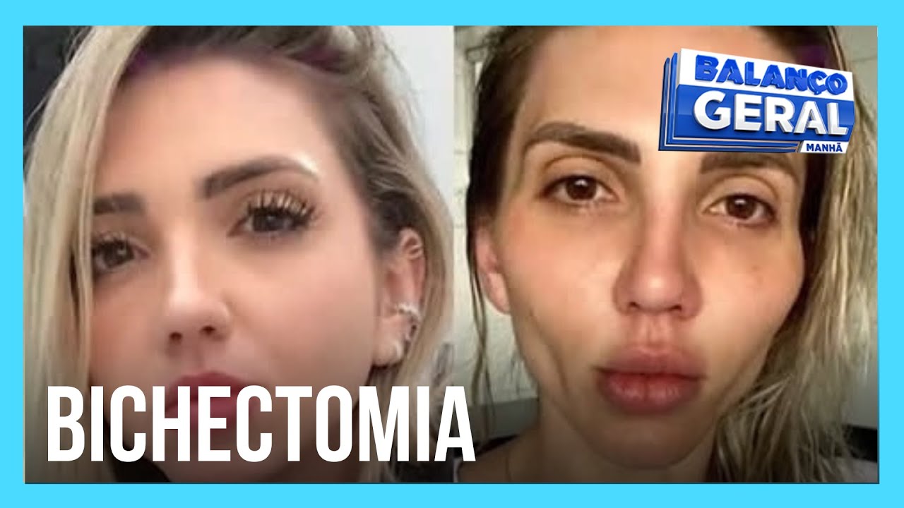 Procedimento para afinar bochechas deixa rosto caído e envelhecido