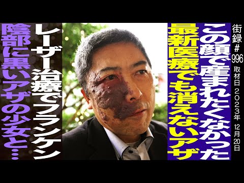 稀な病気を持つ俳優は、外見や反応にどう対処しているかを説明する。「私たちは友達になれるの?」