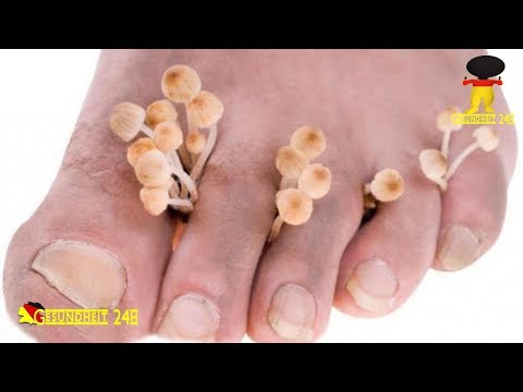 Beim Kind slojatsja die Nägel des Grundes und die Behandlung Das beste Mittel gegen gribka auf den Nägeln der Beine