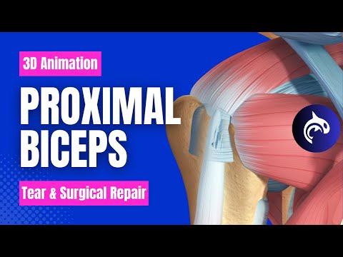 Proximal Biceps Tear and Biceps Tenodesis: Restoring Function and Relieving Pain - 3D Animation