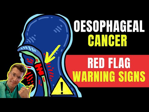 Warning signs & symptoms of OESOPHAGEAL(AKA esophageal /gullet) CANCER - Doctor O'Donovan explains