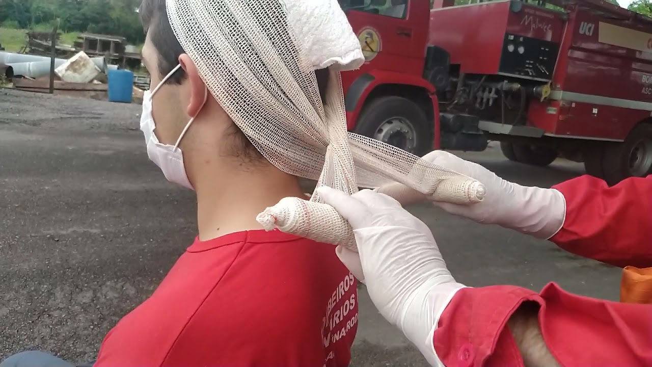 Watch Now FERIMENTO EM TECIDO MOLE NO CRÂNIO - CURATIVO E BANDAGEM DUPLA COM ATADURA DE CREPOM. FERIMENTO EM TECIDO MOLE NO CRÂNIO - CURATIVO E BANDAGEM DUPLA COM ATADURA DE CREPOM.