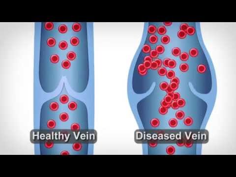 phlebodia cu perei varicosi de recenzii pelvis mici