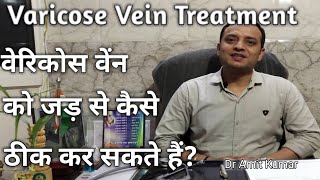 Varicose Veins Treatment | वेरिकोस वेंन को जड़ से कैसे ठीक कर सकते हैं? - Download this Video in MP3, M4A, WEBM, MP4, 3GP