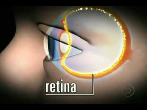 Thumbnail: Fantástico – Retinose Pigmentar
