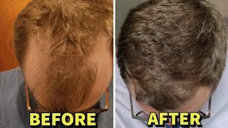 THESE 3 HAIR LOSS MEDS REVERSED HIS BALDING HEAD **INSANE RESULTS**