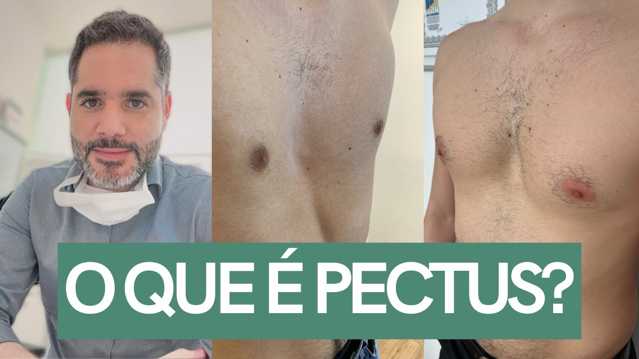 Pectus? Entenda tudo sobre essa deformidade. Peito Fundo e Peito pra Fora tem TRATAMENTO!