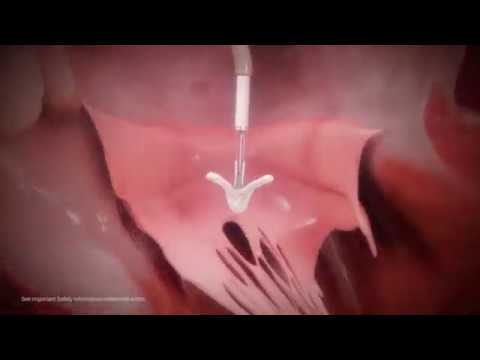 New treatment for severe mitral regurgitation by cardiologist Lee MacDonald MD, MitraClip