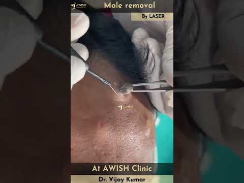 Mole on forehead Removal by RF | Painless mole removing #mole #remove #moles #awishclinic #shorts