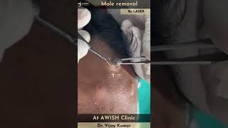 Download lagu Mole on forehead Removal by RF | Painless mole removing #mole #remove #moles #awishclinic #shorts mp3 Download lagu Mole on forehead Removal by RF | Painless mole removing #mole #remove #moles #awishclinic #shorts mp3