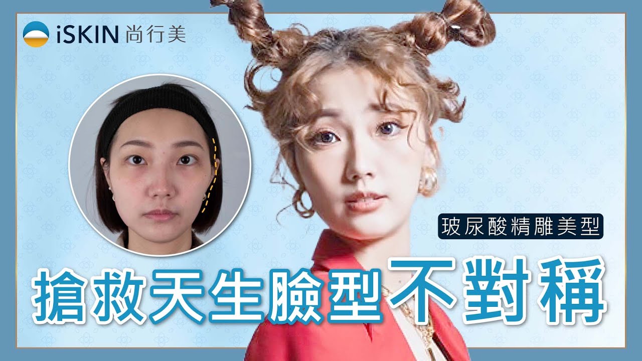 【玻尿酸醫美】搶救天生臉型不對稱、頰凹、夫妻宮凹陷│巫清隆醫師