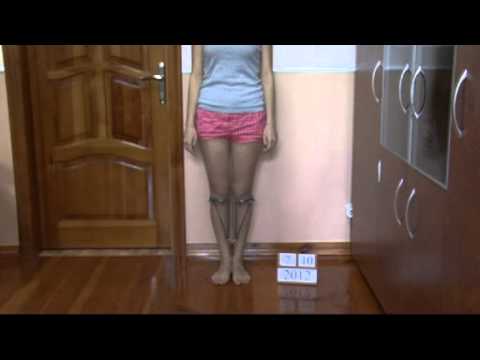 Plantes pour soigner les varices Plantes pour soigner les varices
